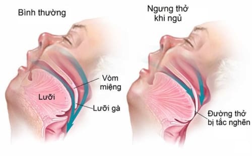hội chứng ngưng thở khi ngủ
