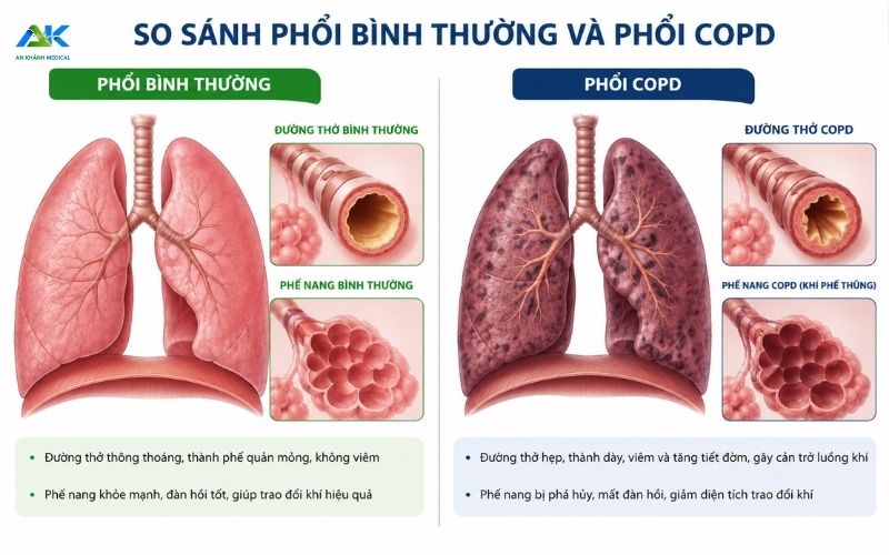 So do phoi binh thuong va phoi COPD